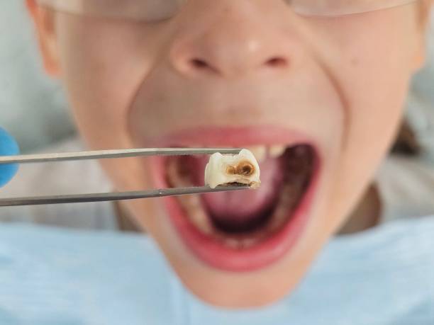 Tooth Infection Emergency Dentist in MI
